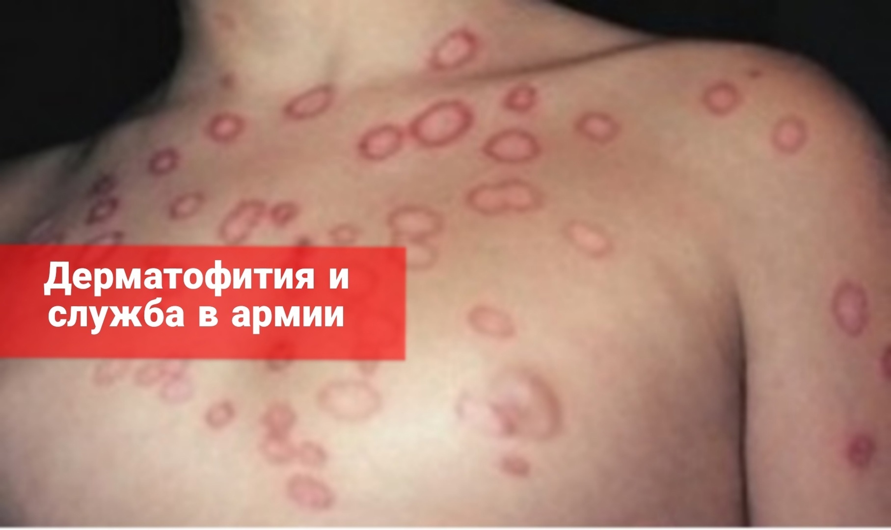Берут ли в армию с дерматофитией