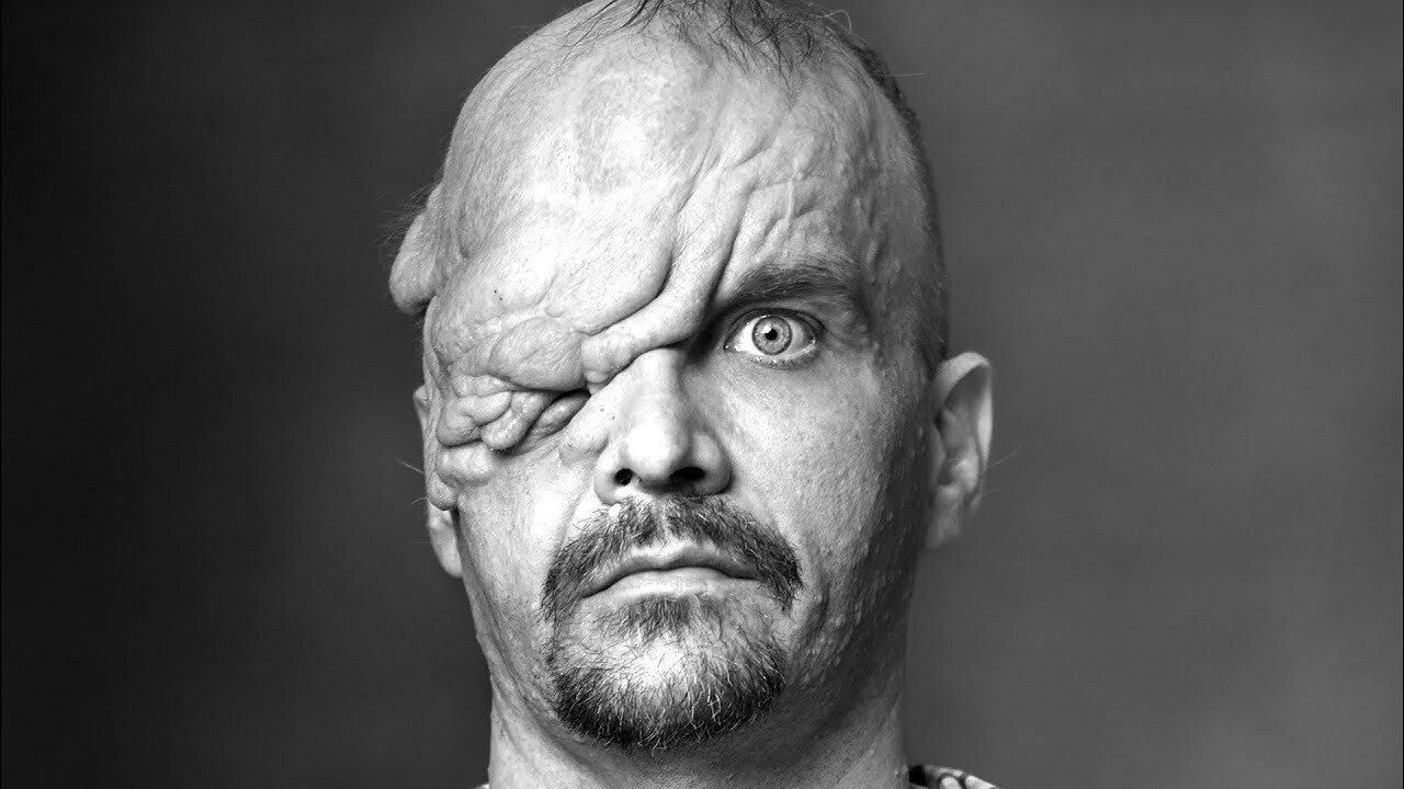 10 страшных болезней, которые безжалостно уродуют людей.