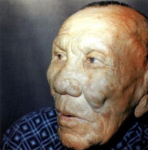 10 страшных болезней, которые безжалостно уродуют людей.