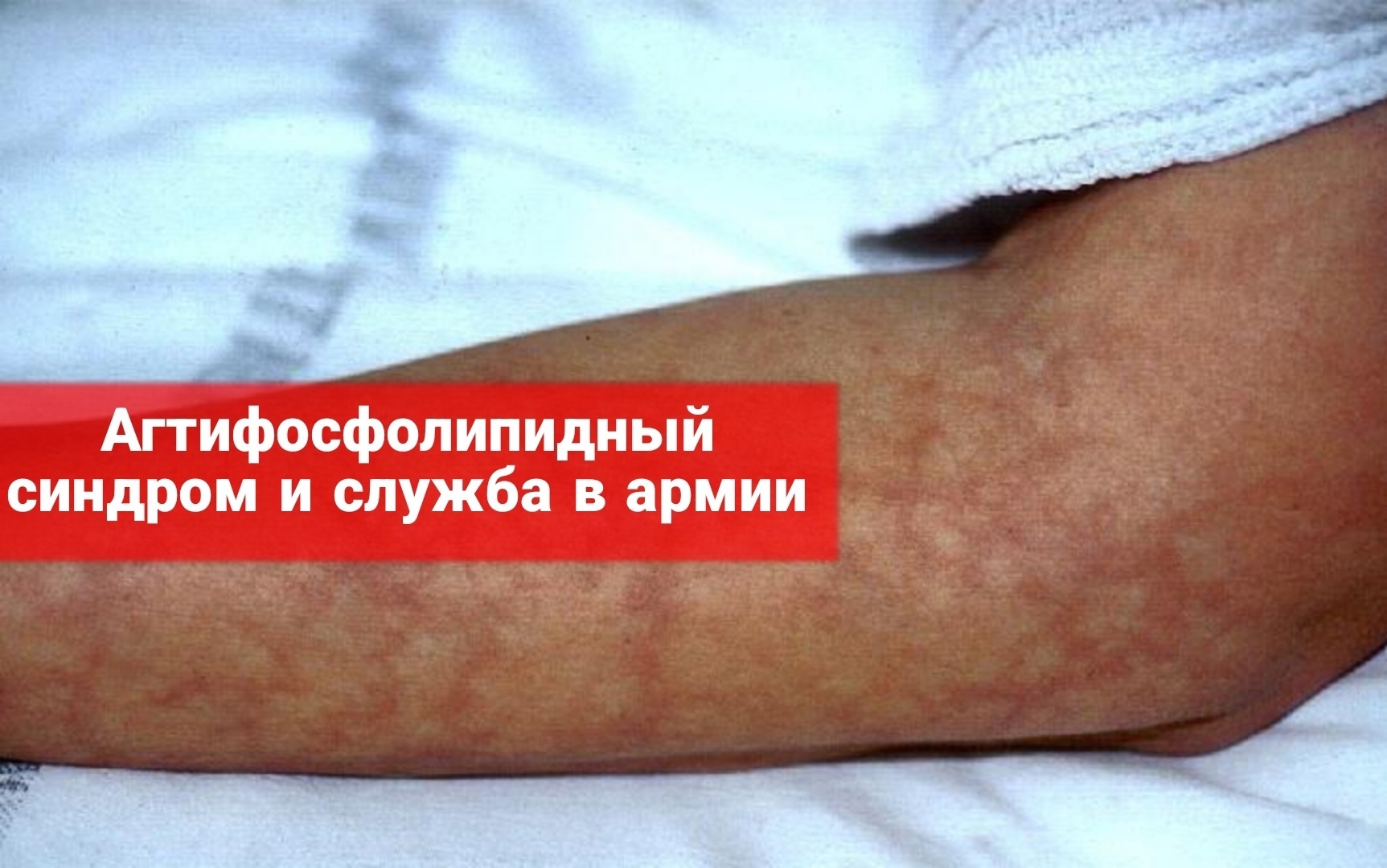 Антифосфолипидный синдром и служба в армии