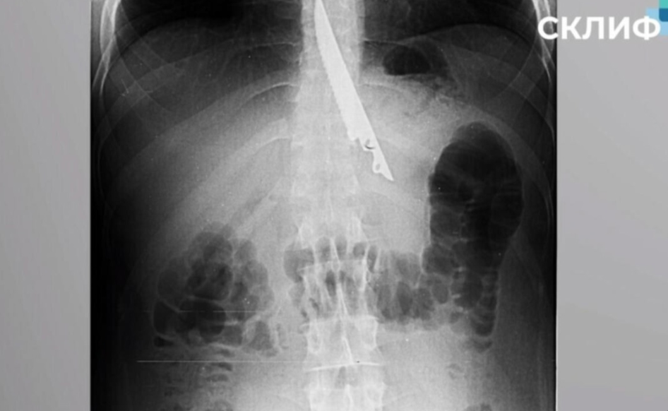 Хотел поесть шашлыков, а оказался в больнице. Мужчина проглотил нож, который друзья засунули ему в горло.