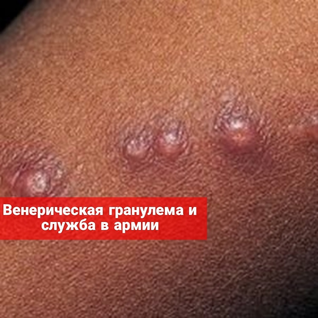 Венерическая гранулема и служба в армии