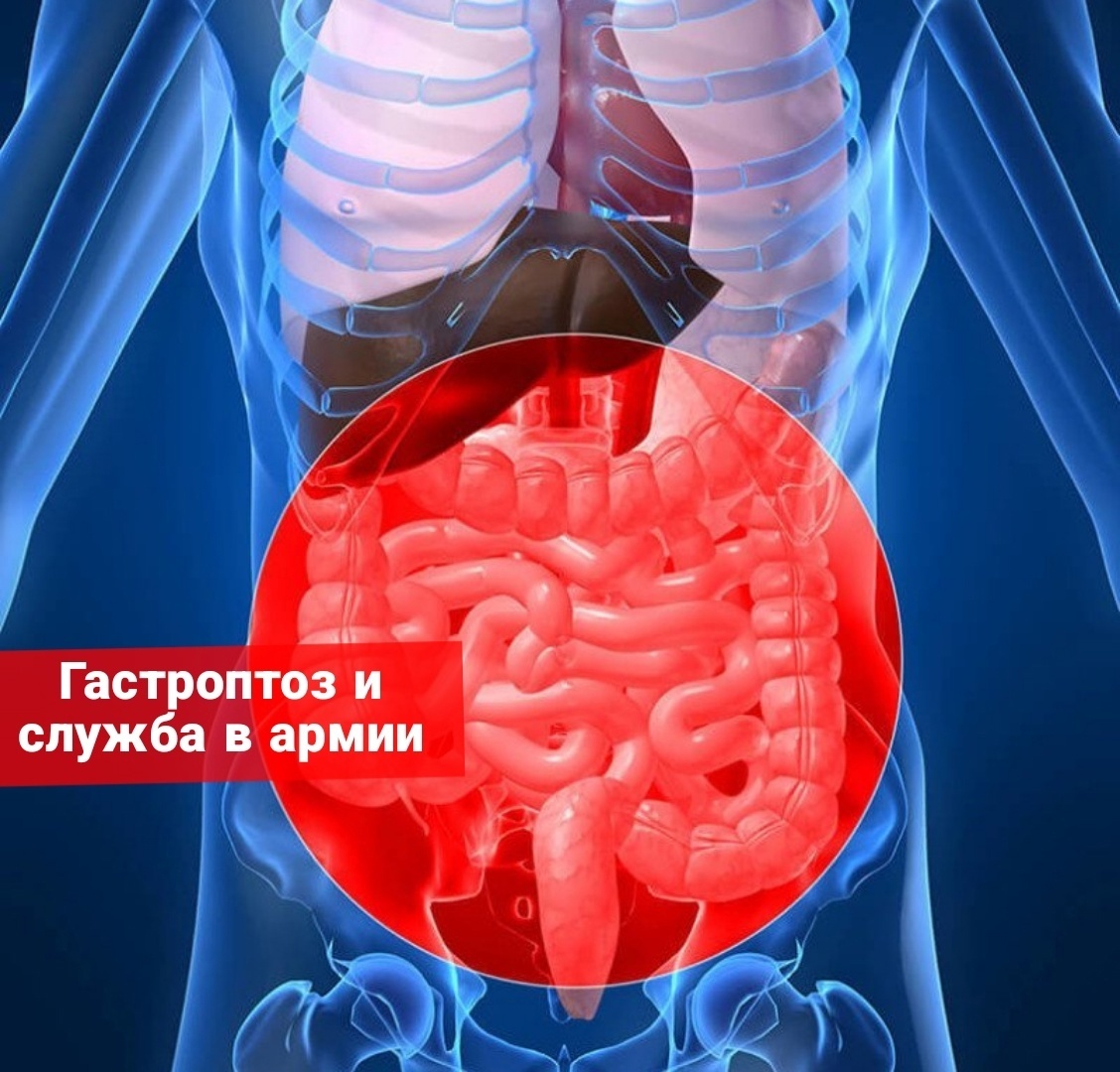 Гастроптоз и служба в армии