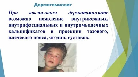 Эффективность внутривенного иммуноглобулина в борьбе с кожными проявлениями дерматомиозита