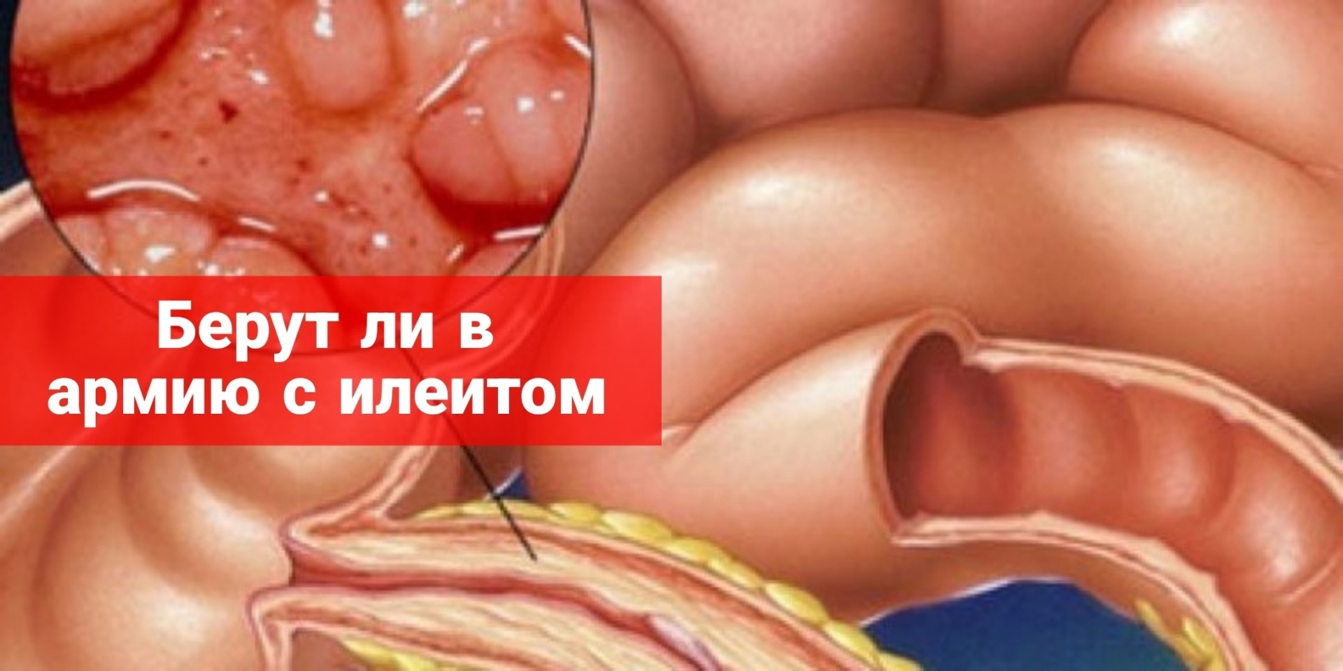 Берут ли в армию с илеитом