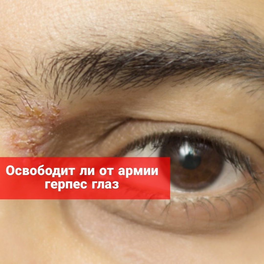 Освободит ли от армии герпес глаз