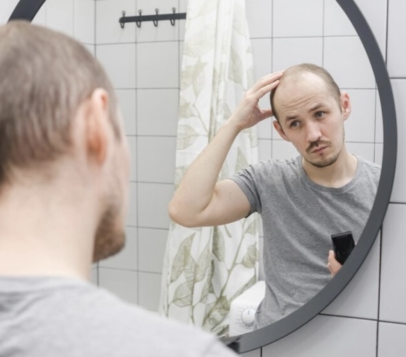 Названы причины залысин на лбу и снижение густоты волос у мужчин. Как лечить и «смешные» цены