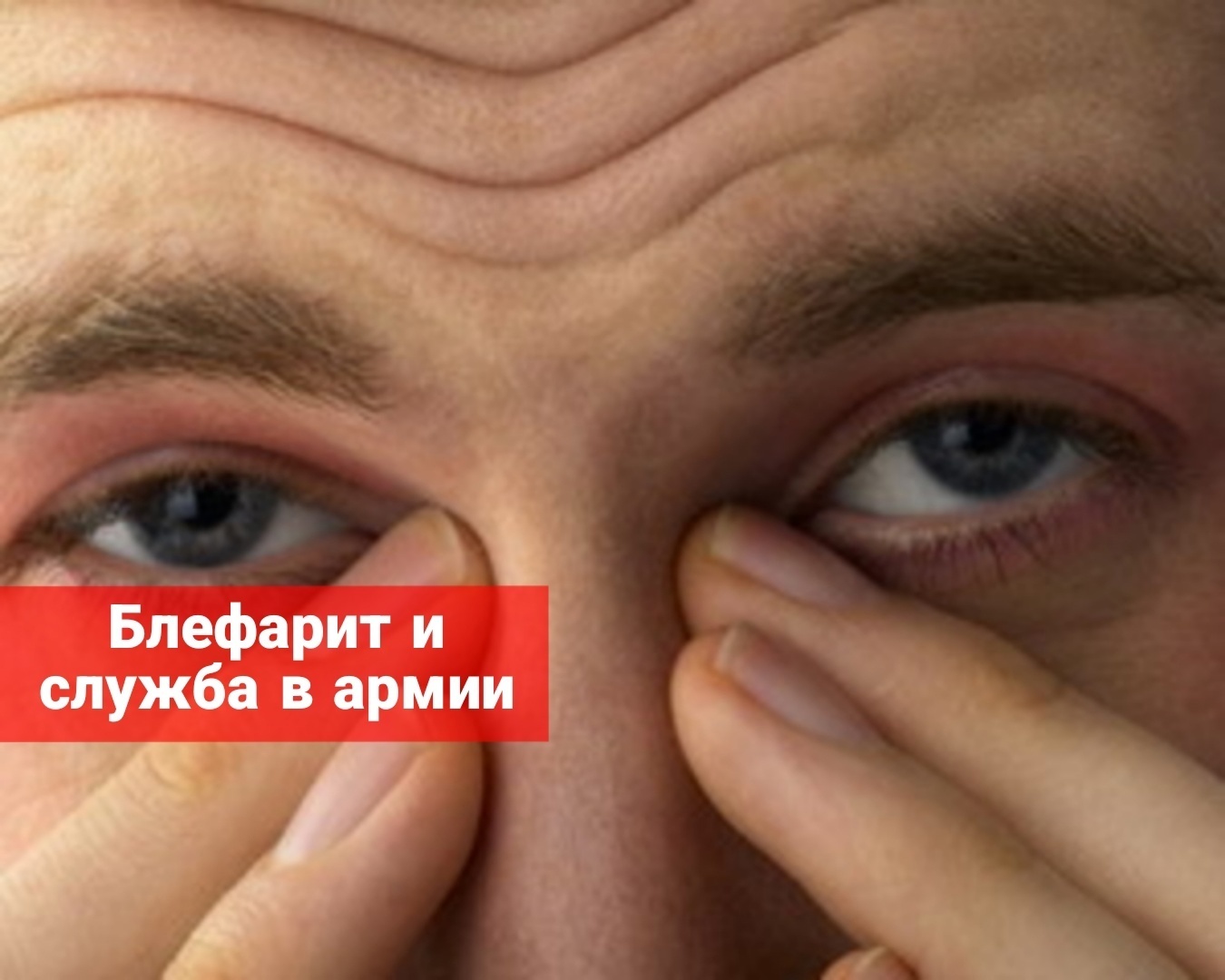 Блефарит и служба в армии