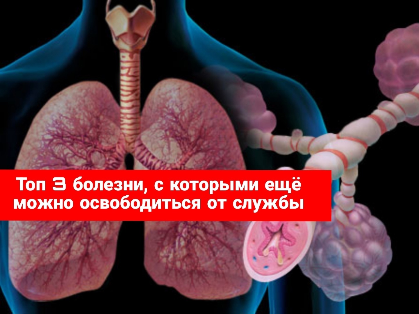 Топ 3 заболевания, с которыми еще можно освободиться от службы в армии