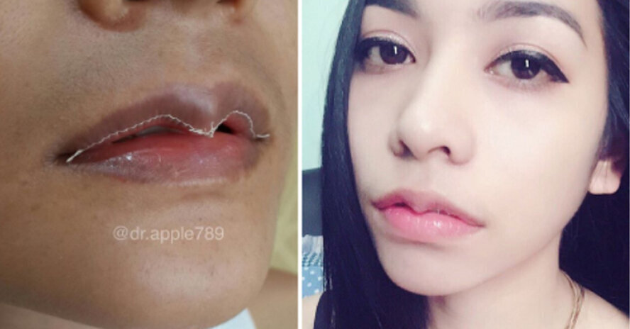 Тренд на «губы-чайки»: как погоня за идеалом уродует людей.