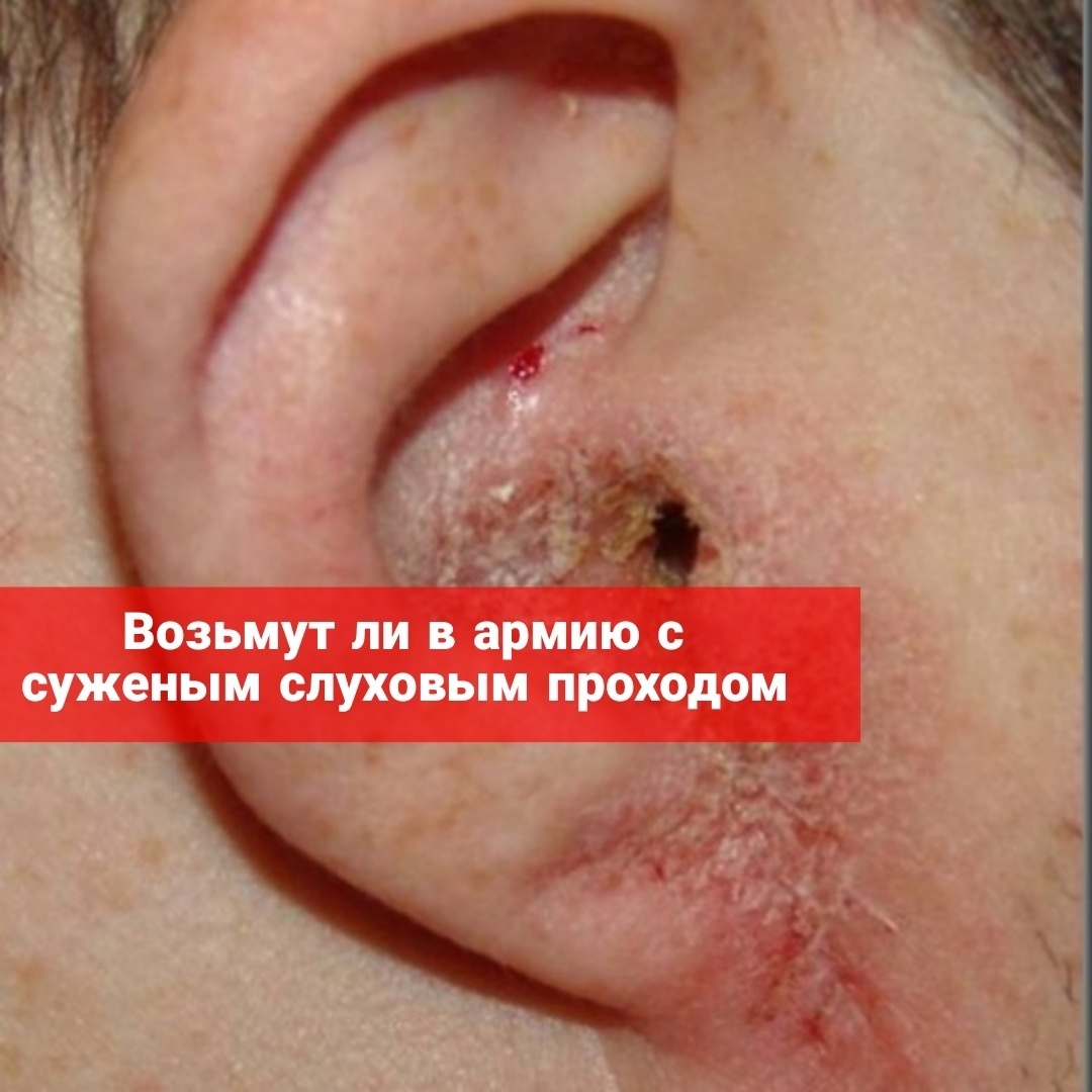 Возьмут ли в армию с суженным слуховым проходом