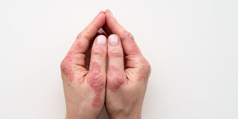 Отказ при устройстве на работу псориаз