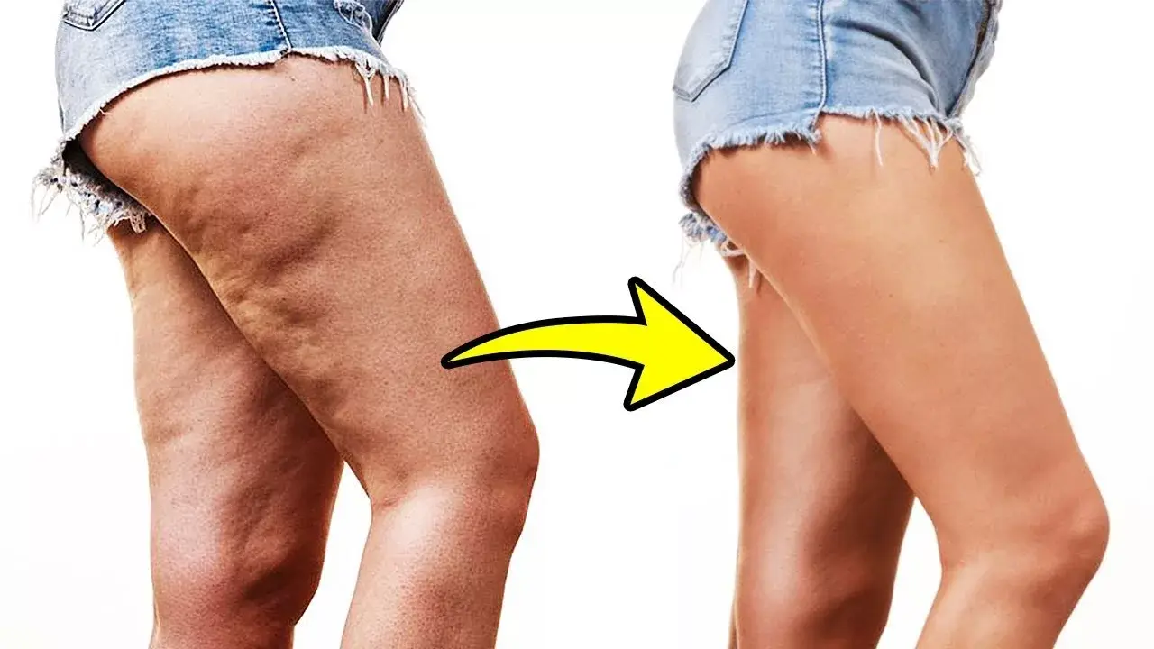 Целлюлит откуда берётся, и как с ним бороться