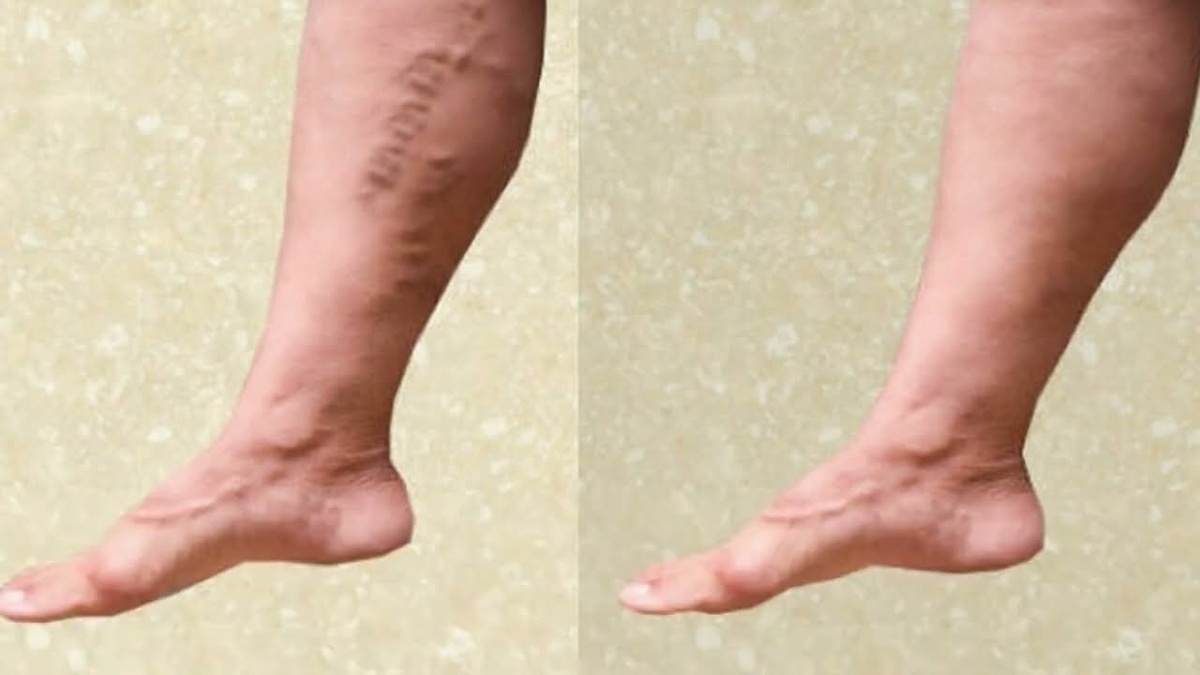 Варикоз: как избавиться от боли и вернуть здоровье ног без операций и дорогих процедур