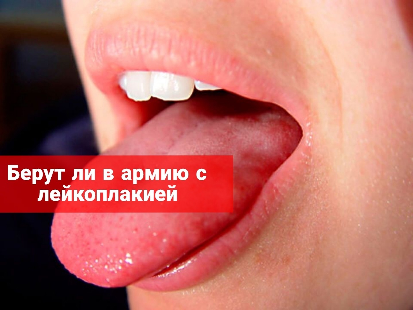 Берут ли в армию с лейкоплакией