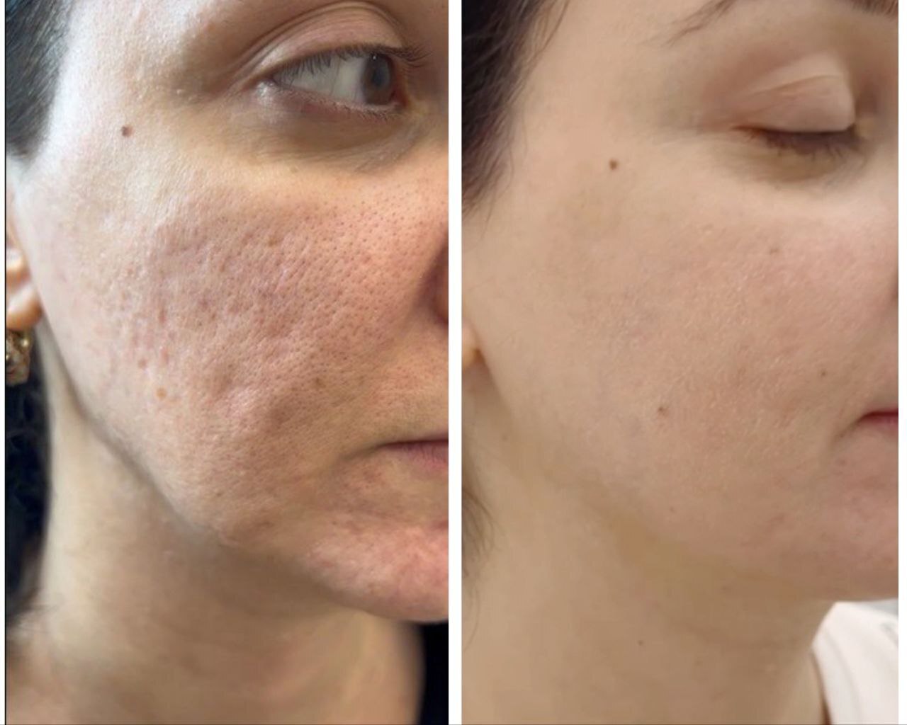 Как кожа помнит всё. Рассказ врача о лечении рубцов