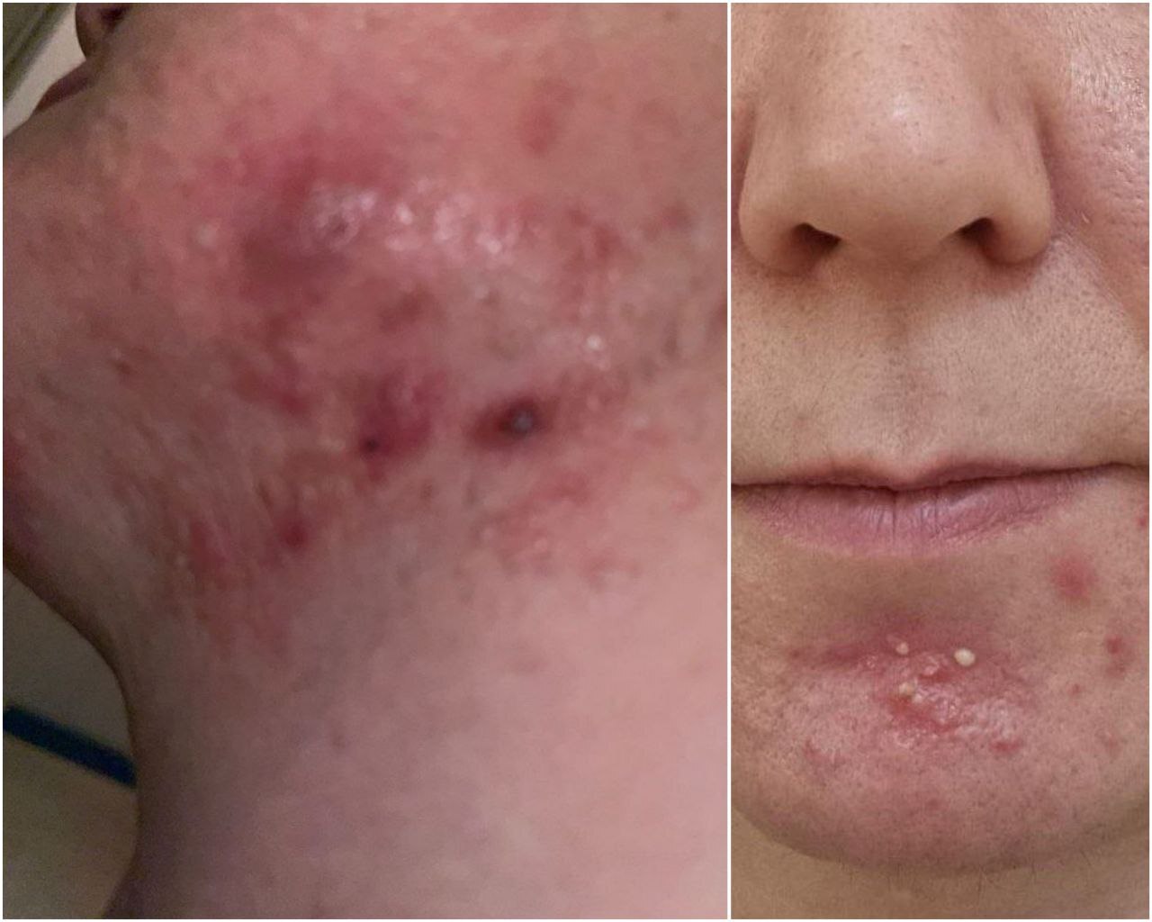 Как кожа помнит всё. Рассказ врача о лечении рубцов