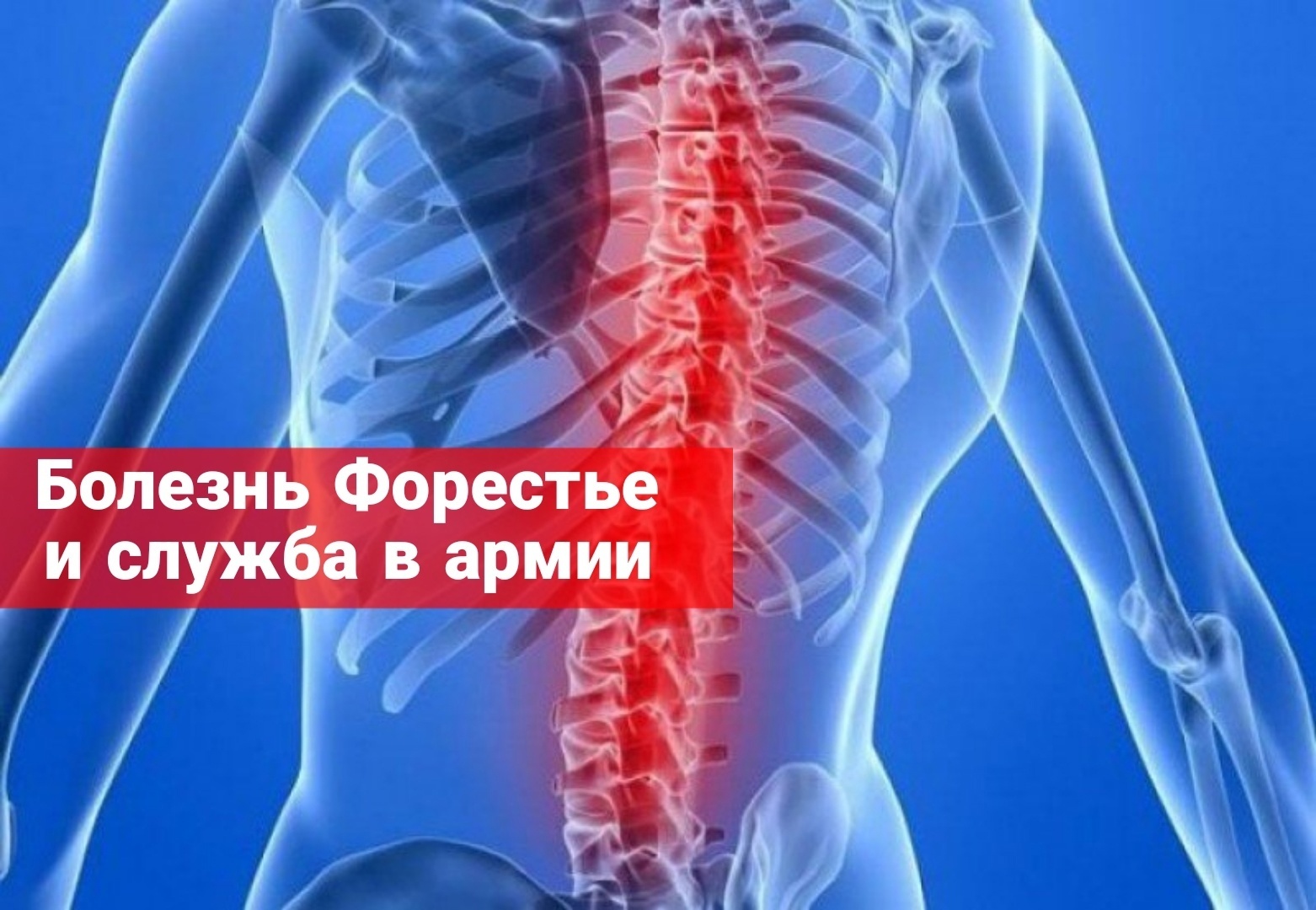 Болезнь Форестье и служба в армии