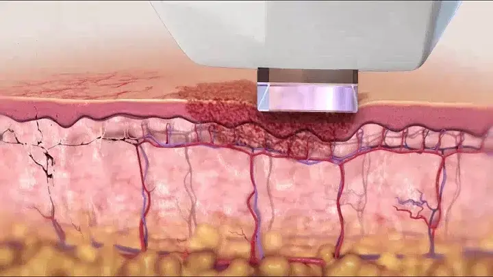 Люмека: не просто омолаживает — она лечит кожу