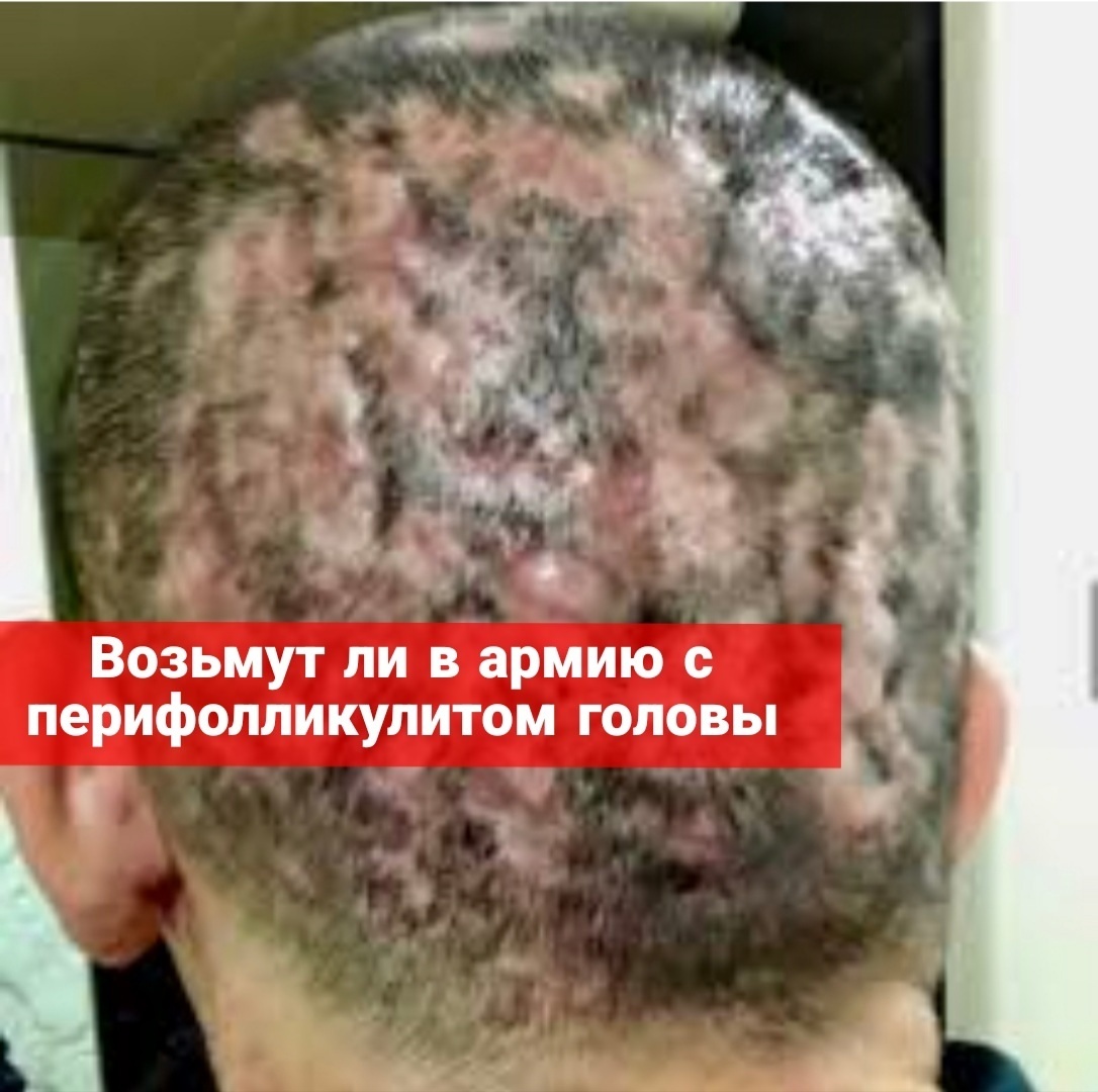 Берут ли в армию с перифолликулитом головы?
