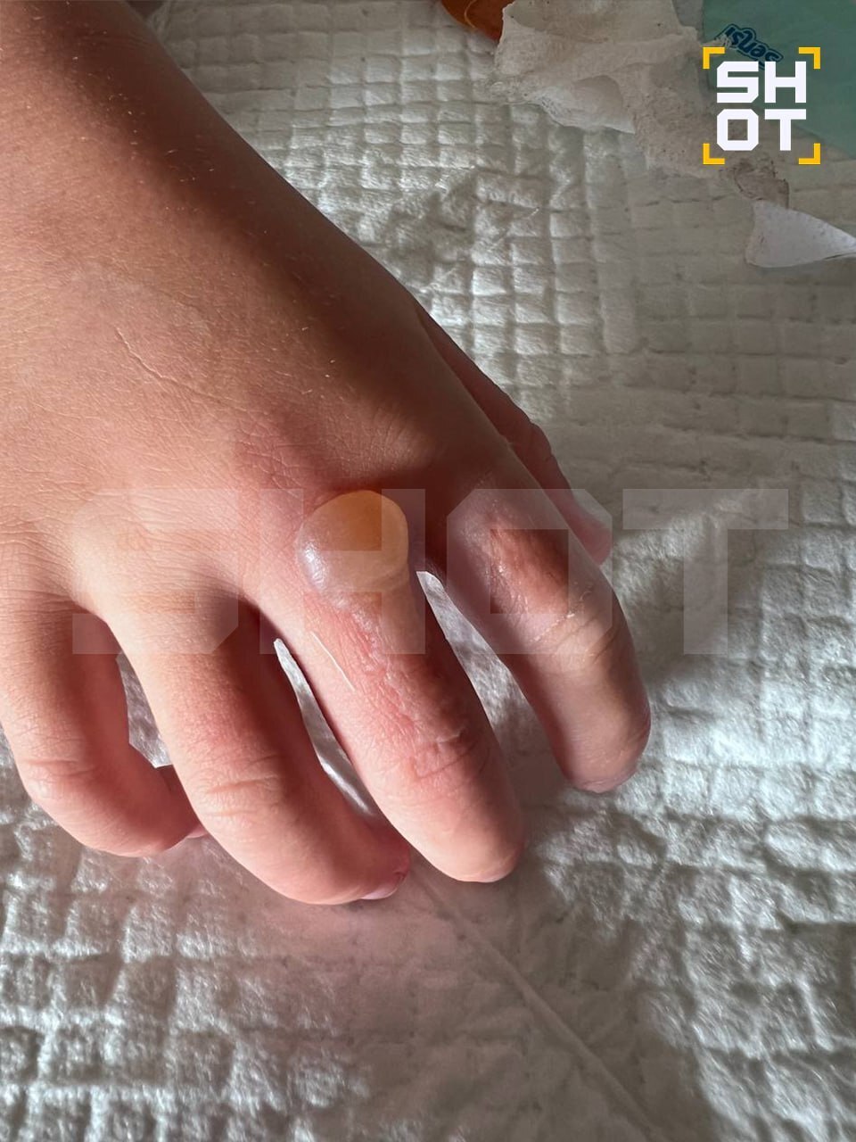 На российских туристов во Вьетнаме и Индонезии нападают летающие ядовитые жуки, оставляя на их коже ожоги и язвы