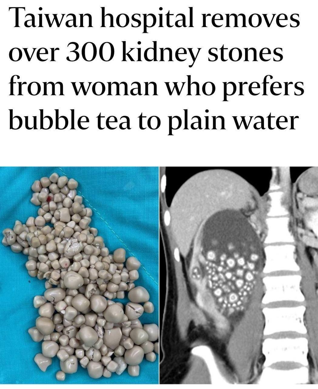 ❗️ У 20-летней девушки нашли более 300 КАМНЕЙ В ПОЧКАХ из-за ежедневного употребления бабл-ти, сока и алкоголя