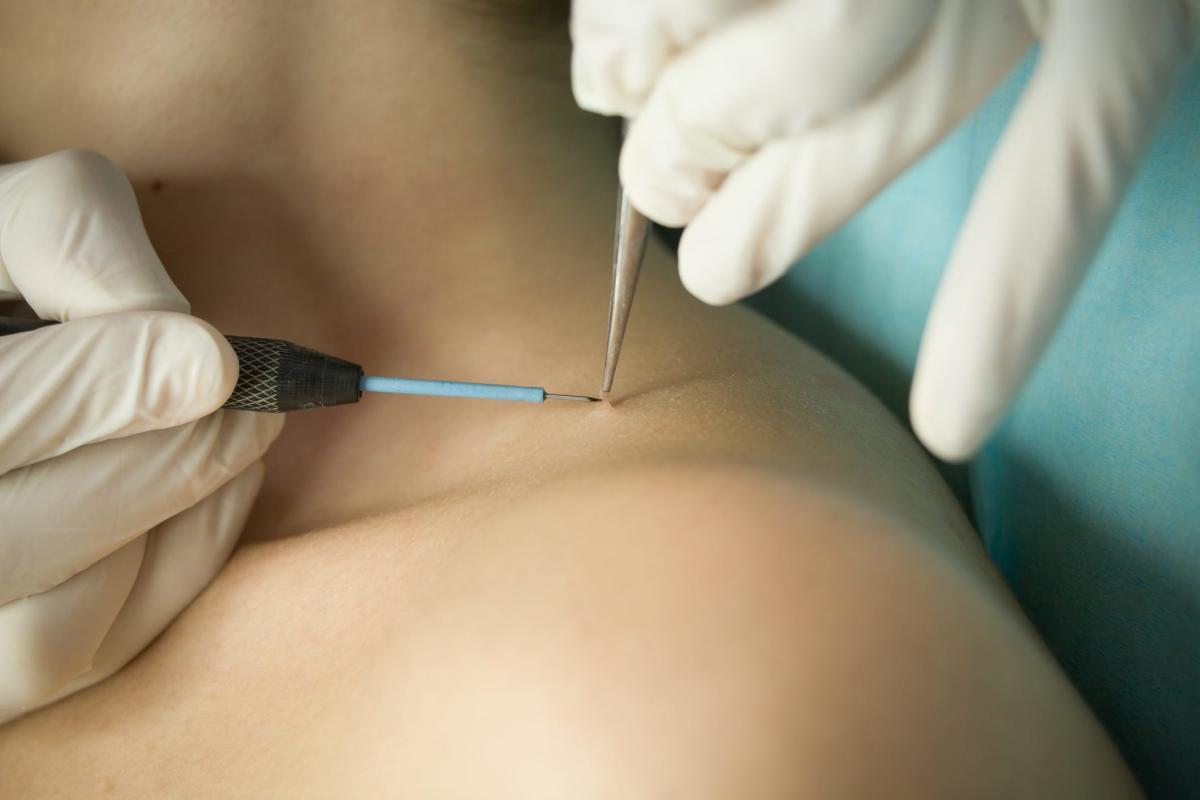 Папилломы: безобидные точки или сигнал о серьёзной проблеме внутри тела?