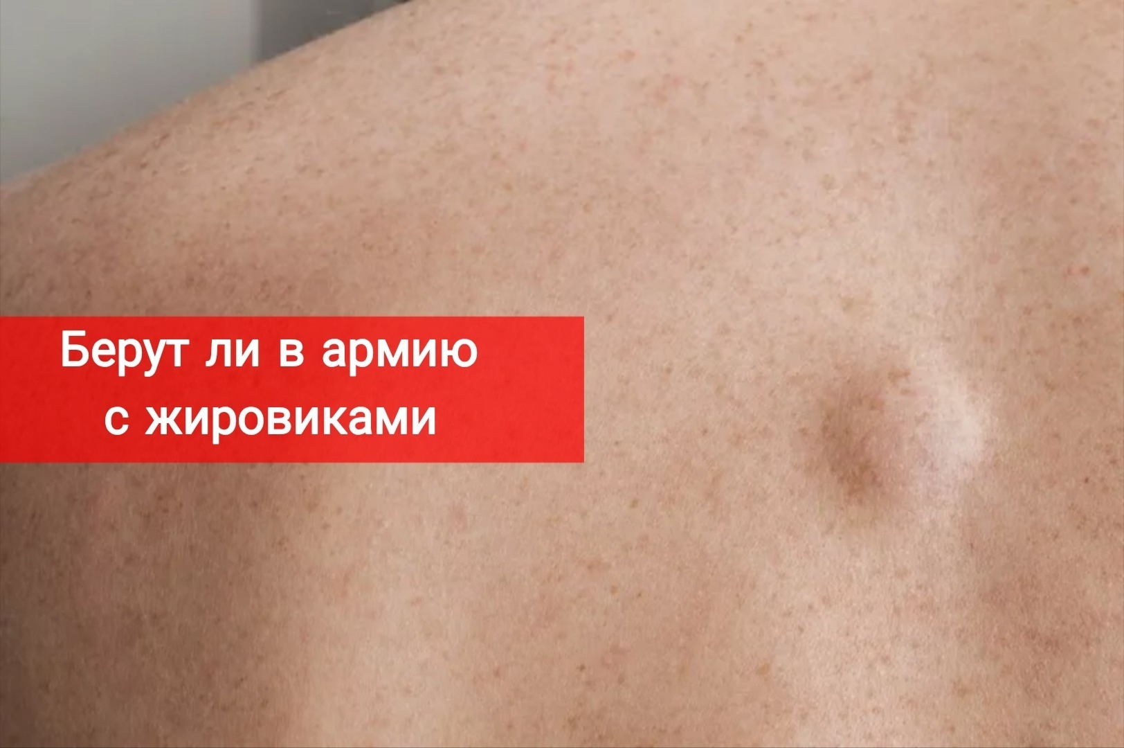 Берут ли в армию с жировиками