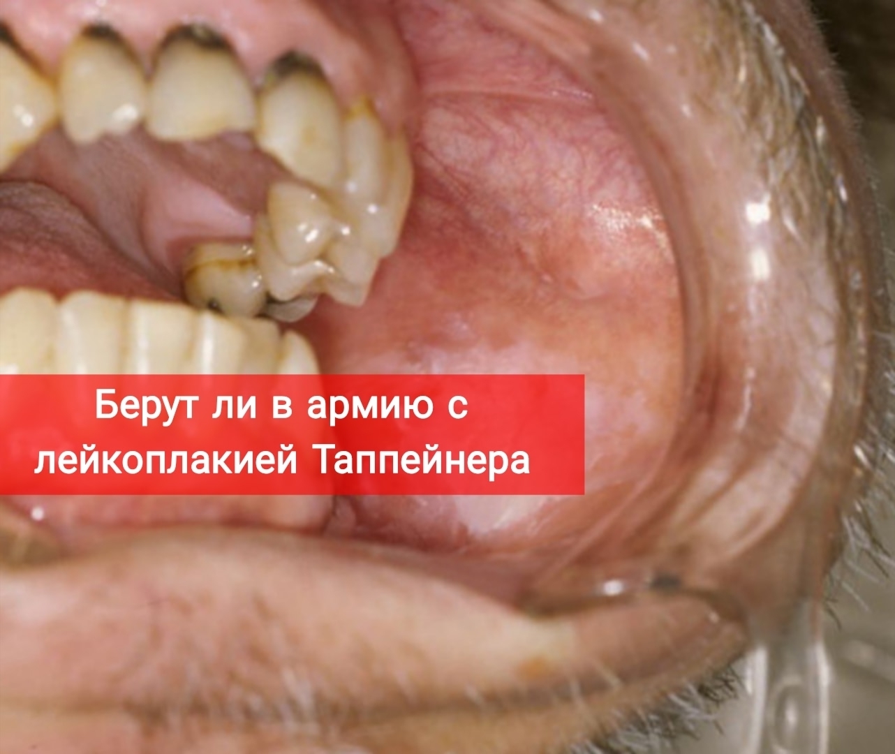 Берут ли в армию с лейкоплакией Таппейнера