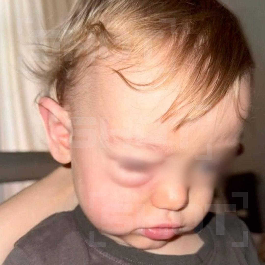 В Москве младенец едва не потерял зрение из‑за неправильного промывания носа.