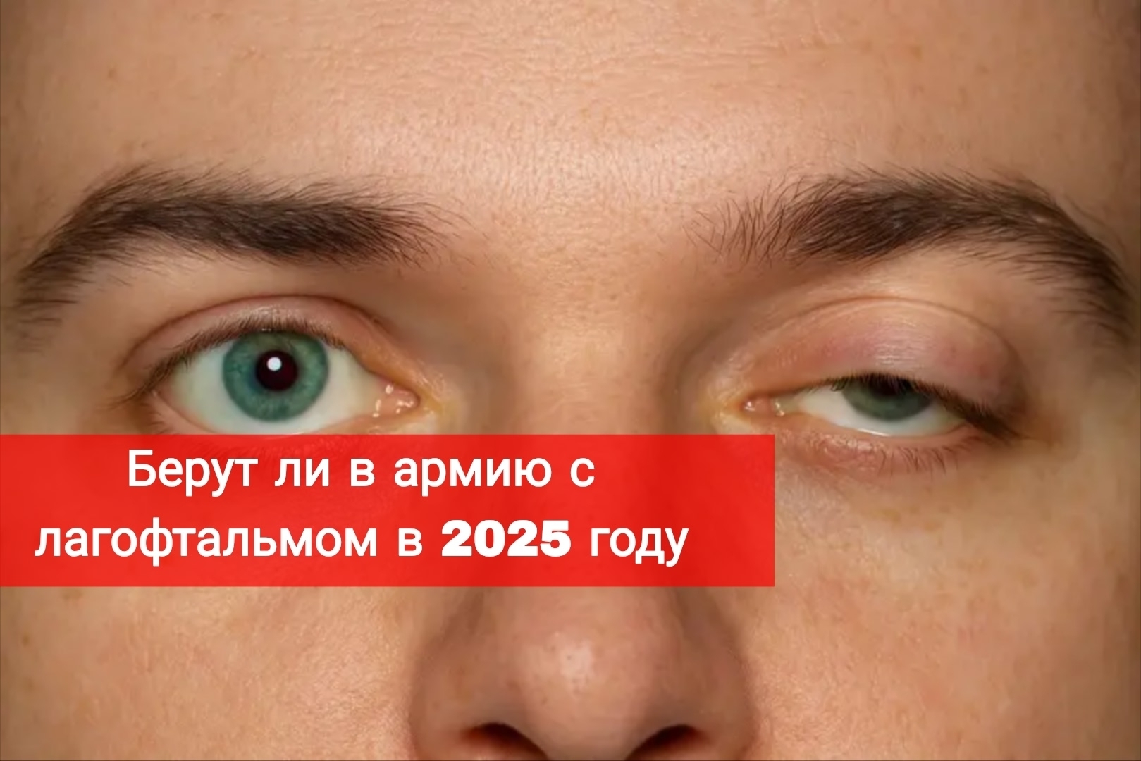 Берут ли в армию с лагофтальмом в 2025 году?